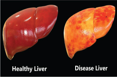 liver--3